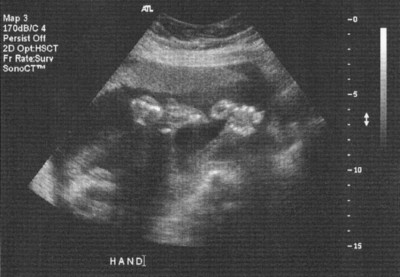 Ultrasound Hand